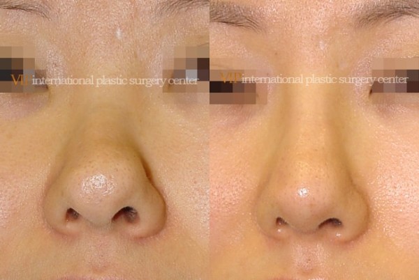 Nose Surgery - Bulbous nose rhinoplasty