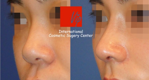 	Nose Surgery, Harmony-Rhinoplasty, Protruded Mouth Correction Rhinoplasty, Rib cartilage Rhinoplasty, Each Cases Nose	 - VIP Harmony rhinoplasty (correction of mid face retrusion & protruded mouth)