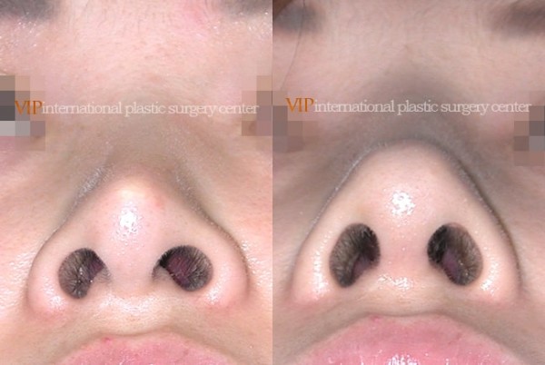 Nose Surgery - Revision rhinoplasty - Silicone showing nose