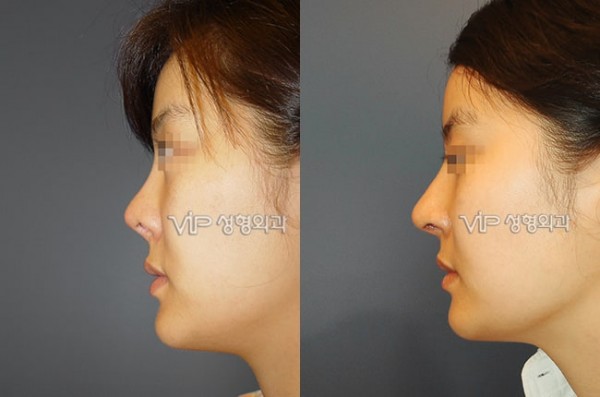 	Nose Surgery, Rib cartilage Rhinoplasty	 - Revision of short nose - Rib cartilage rhinoplasty