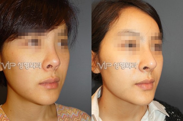 	Nose Surgery, Rib cartilage Rhinoplasty	 - Revision of short nose - Rib cartilage rhinoplasty