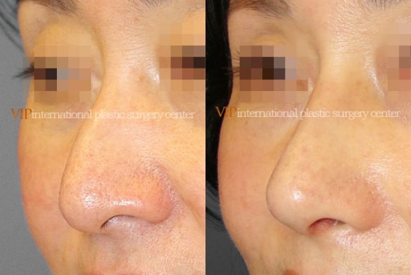 Nose Surgery - Rhinoplasty