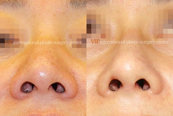 Nose Surgery - Rhinoplasty