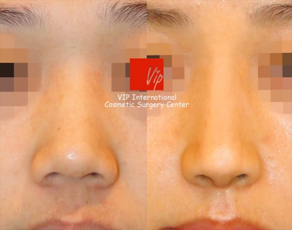 	Harmony-Rhinoplasty, Protruded Mouth Correction Rhinoplasty, Rib cartilage Rhinoplasty	 - Harmony rhinoplasty