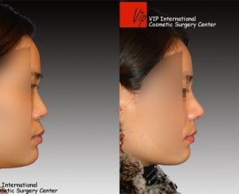 VIP Harmony rhinoplasty (correction of mid face retrusion & …