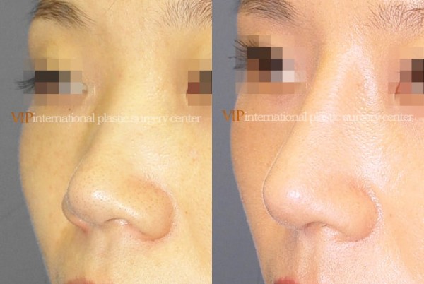 Nose Surgery - Alar base reduction