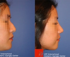 Humped nose correction rhinoplasty