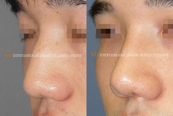 	Nose Surgery	 - Wide nasal bone reduction rhinoplasty