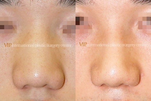 	Nose Surgery	 - Wide nasal bone reduction rhinoplasty