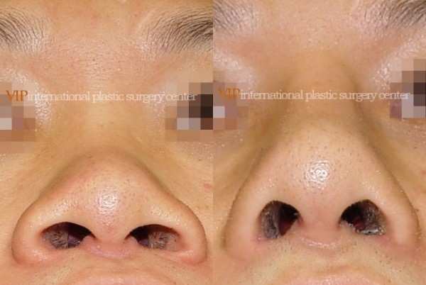 Nose Surgery - Alar base reduction