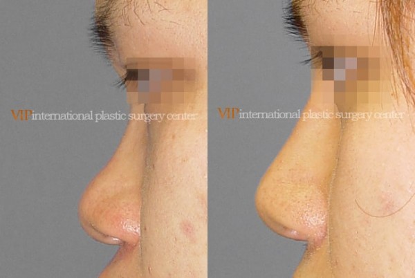 Nose Surgery - Alar base reduction