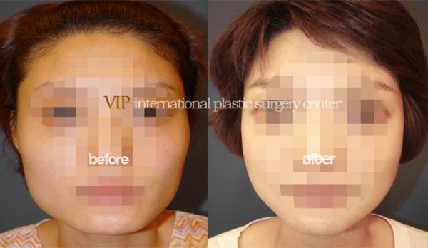 Facial Bone Surgery - Asymmetric jaw line correction