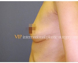 Breast surgery