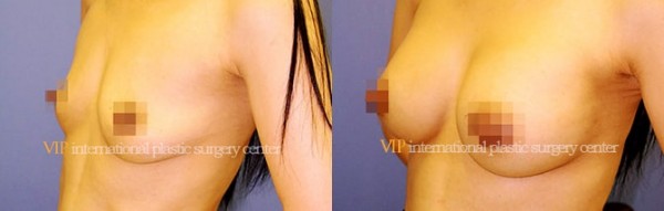 Breast Surgery - Breast surgery