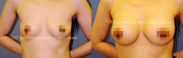 Breast Surgery - Breast surgery