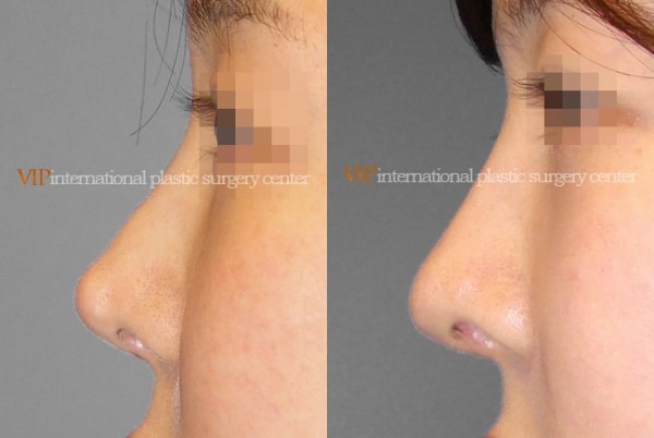 	Nose Surgery, Revision Rhinoplasty	 - Silicone showing nose