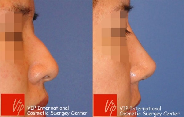 	Nose Surgery, Rib cartilage Rhinoplasty, Each Cases Nose	 - Humped nose correction rhinoplasty