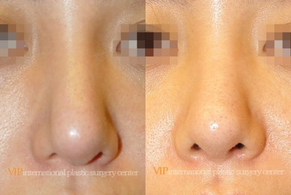 	Nose Surgery	 - Long and Bulbous nose correction