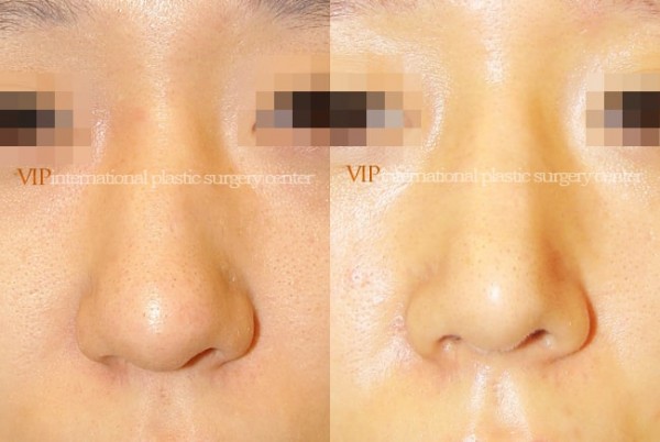 Nose Surgery - Rhinoplasty