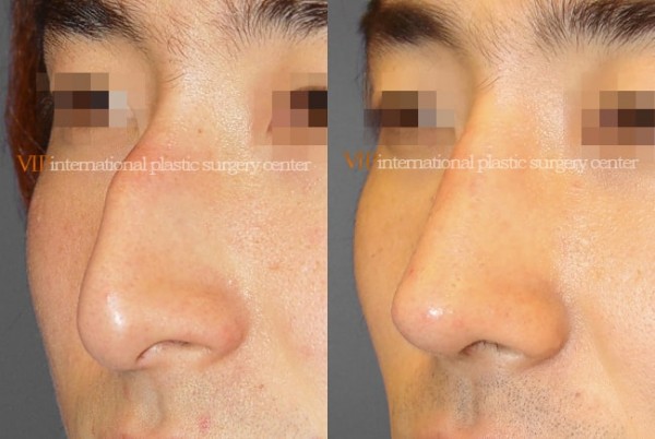 Nose Surgery - Nose bridge correction