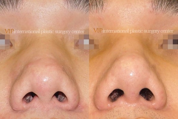 	Nose Surgery	 - Wide nasal bone reduction rhinoplasty