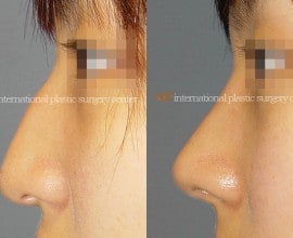 Nose bridge correction