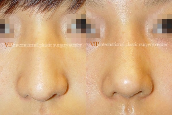 Nose Surgery - Nose bridge correction