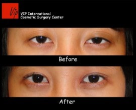 Ptosis correction