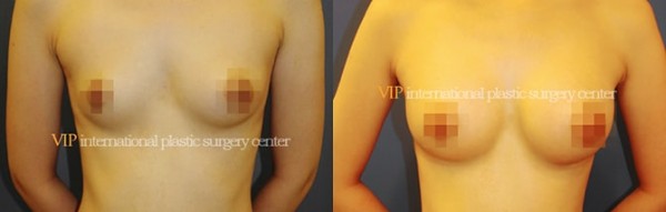 Breast Surgery - Breast surgery