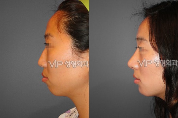 	Harmony-Rhinoplasty, Protruded Mouth Correction Rhinoplasty, Rib cartilage Rhinoplasty	 - VIP Harmony rhinoplasty