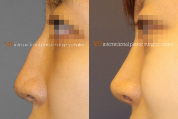 Nose Surgery - Nose bridge correction