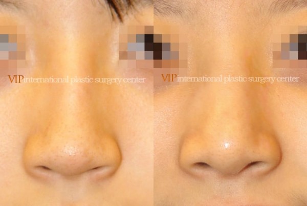 Nose Surgery - Nose bridge correction