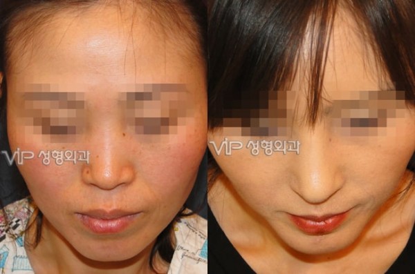 Nose Surgery - VIP Harmony rhinoplasty