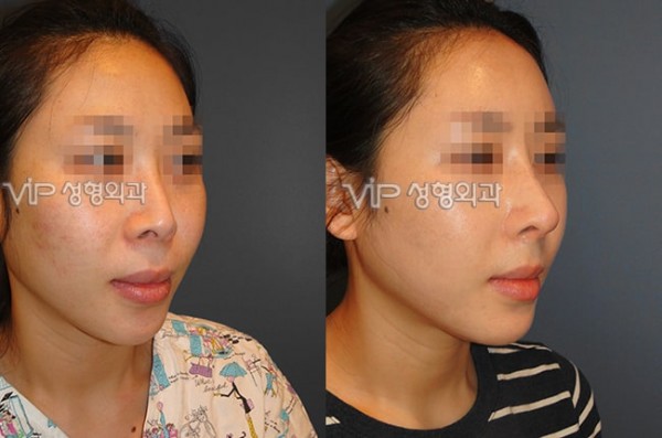 	Rib cartilage Rhinoplasty, Contracted Nose, Revision Rhinoplasty	 - Rib cartilage rhinoplasty