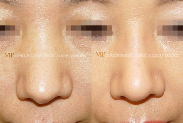 	Nose Surgery, Revision Rhinoplasty	 - Silicone showing nose correction