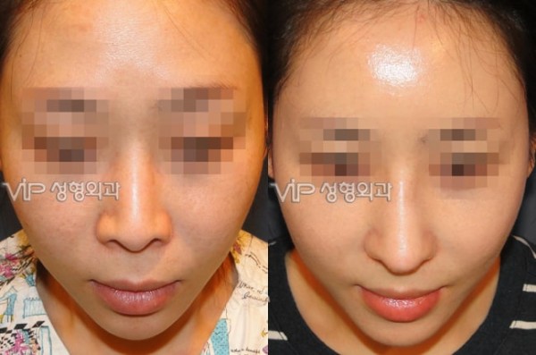 	Rib cartilage Rhinoplasty, Contracted Nose, Revision Rhinoplasty	 - Rib cartilage rhinoplasty