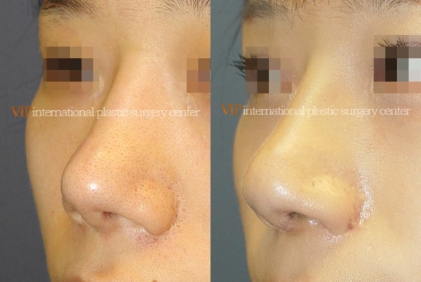 Nose Surgery - Nostril correction