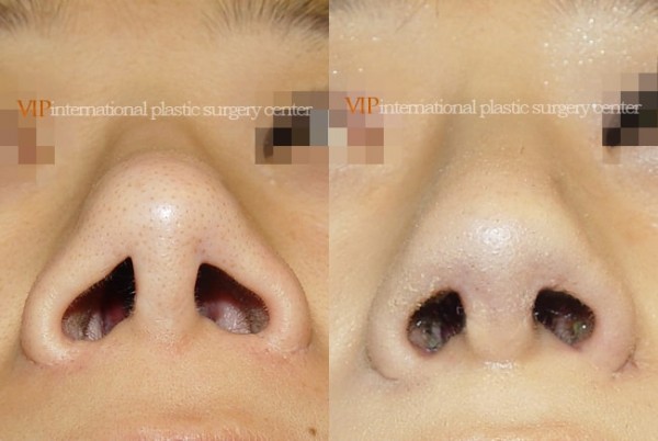 Nose Surgery - Nostril correction