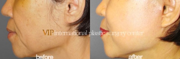 Face Lift - Wrinkle surgery