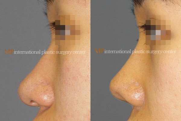 Nose Surgery - Alar base reduction