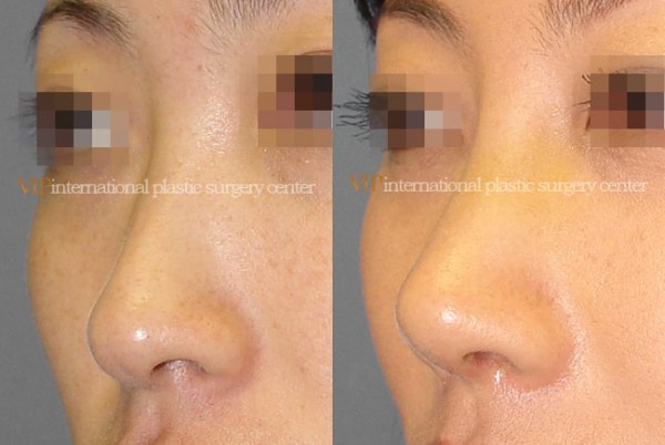 Nose Surgery - Septal cartilage rhinoplasty