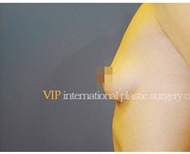 Breast surgery