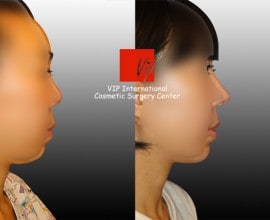 Harmony rhinoplasty - Septal deviation correction+balanced p…