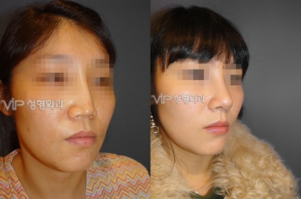 	Harmony-Rhinoplasty, Protruded Mouth Correction Rhinoplasty, Rib cartilage Rhinoplasty	 - VIP Harmony rhinoplasty