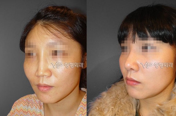 	Harmony-Rhinoplasty, Protruded Mouth Correction Rhinoplasty, Rib cartilage Rhinoplasty	 - VIP Harmony rhinoplasty