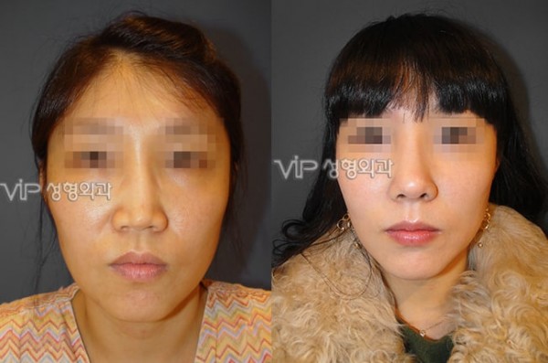 	Harmony-Rhinoplasty, Protruded Mouth Correction Rhinoplasty, Rib cartilage Rhinoplasty	 - VIP Harmony rhinoplasty