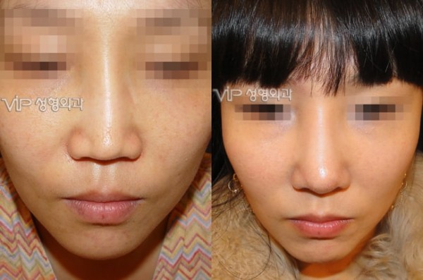 	Harmony-Rhinoplasty, Protruded Mouth Correction Rhinoplasty, Rib cartilage Rhinoplasty	 - VIP Harmony rhinoplasty