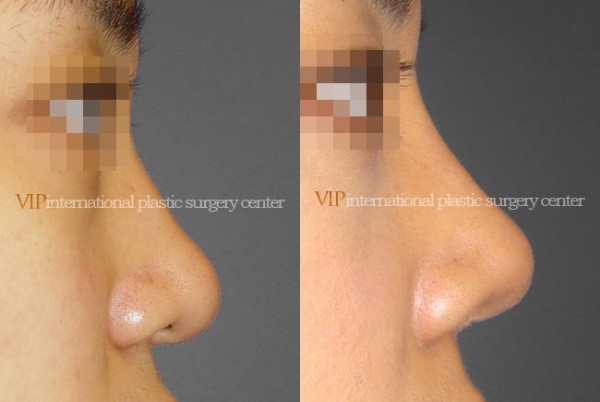 	Nose Surgery	 - Wide nasal bone reduction rhinoplasty