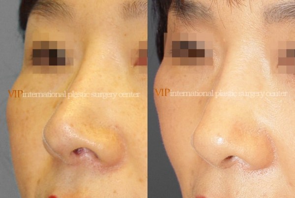 Nose Surgery - Revision rhinoplasty - Tip correction