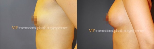 Breast Surgery - Breast surgery